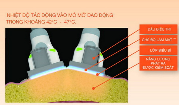 cách thức giảm béo của sculpsure giam beo sculpsure 2.jpg (60 KB)